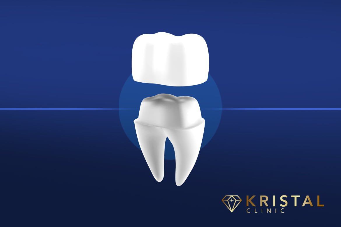 Dental Crowns