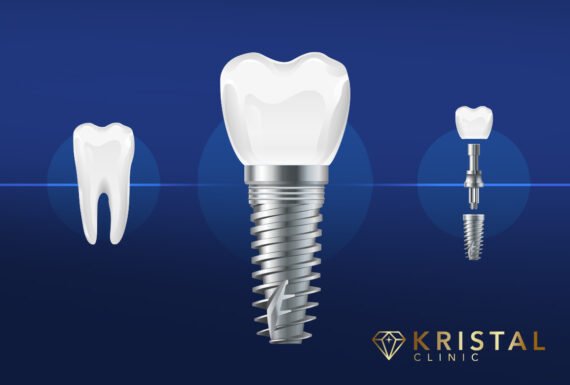 dental implants