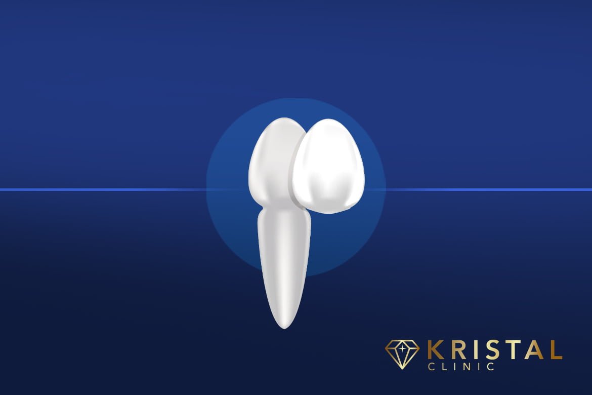 Dental Veneers