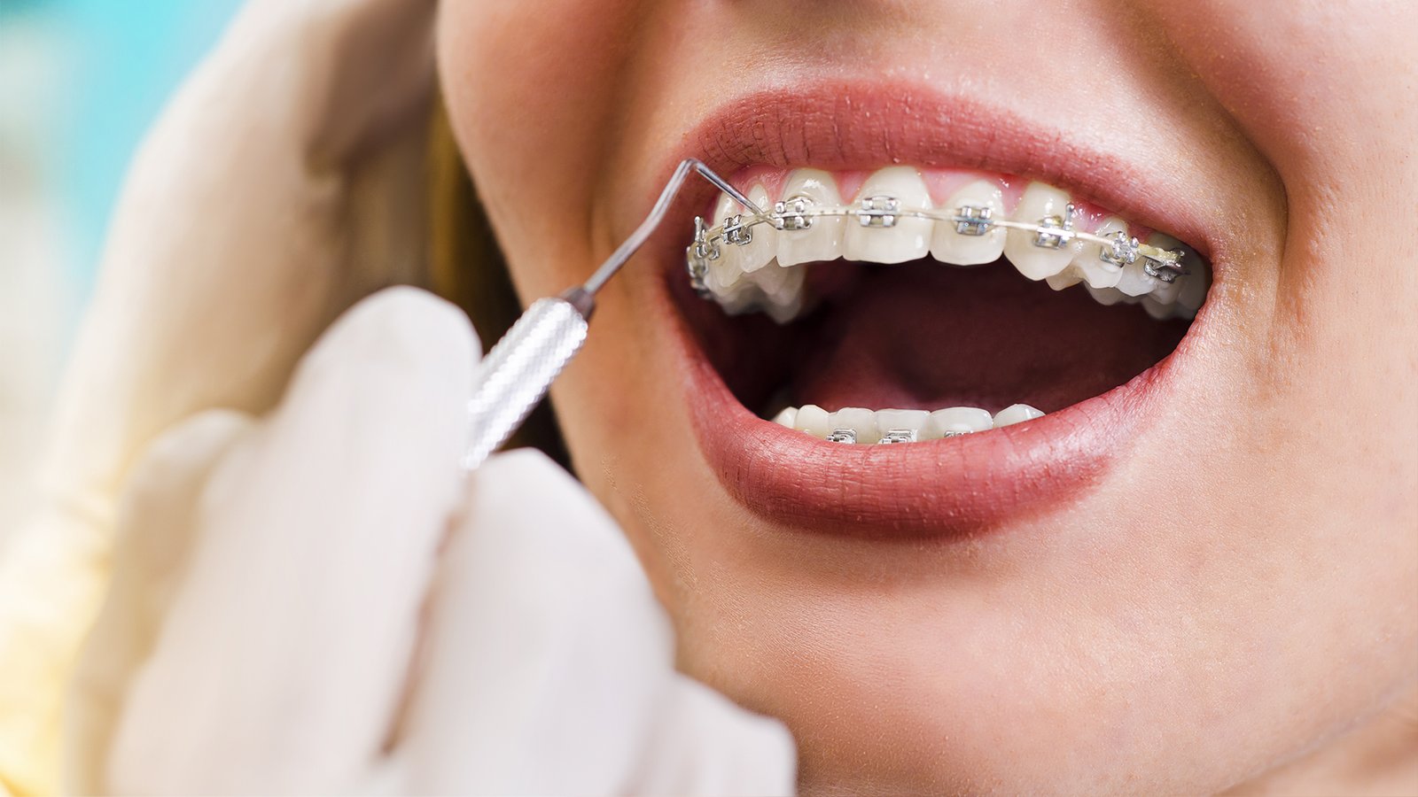 What is an orthodontic braces?