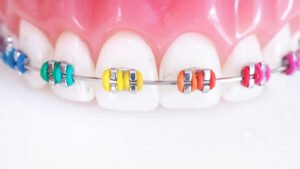 colored braces