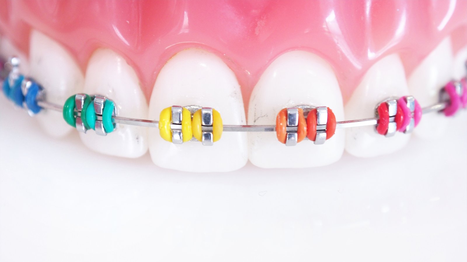 Can Colored Braces Brighten Your Smile at Kristal Clinic?