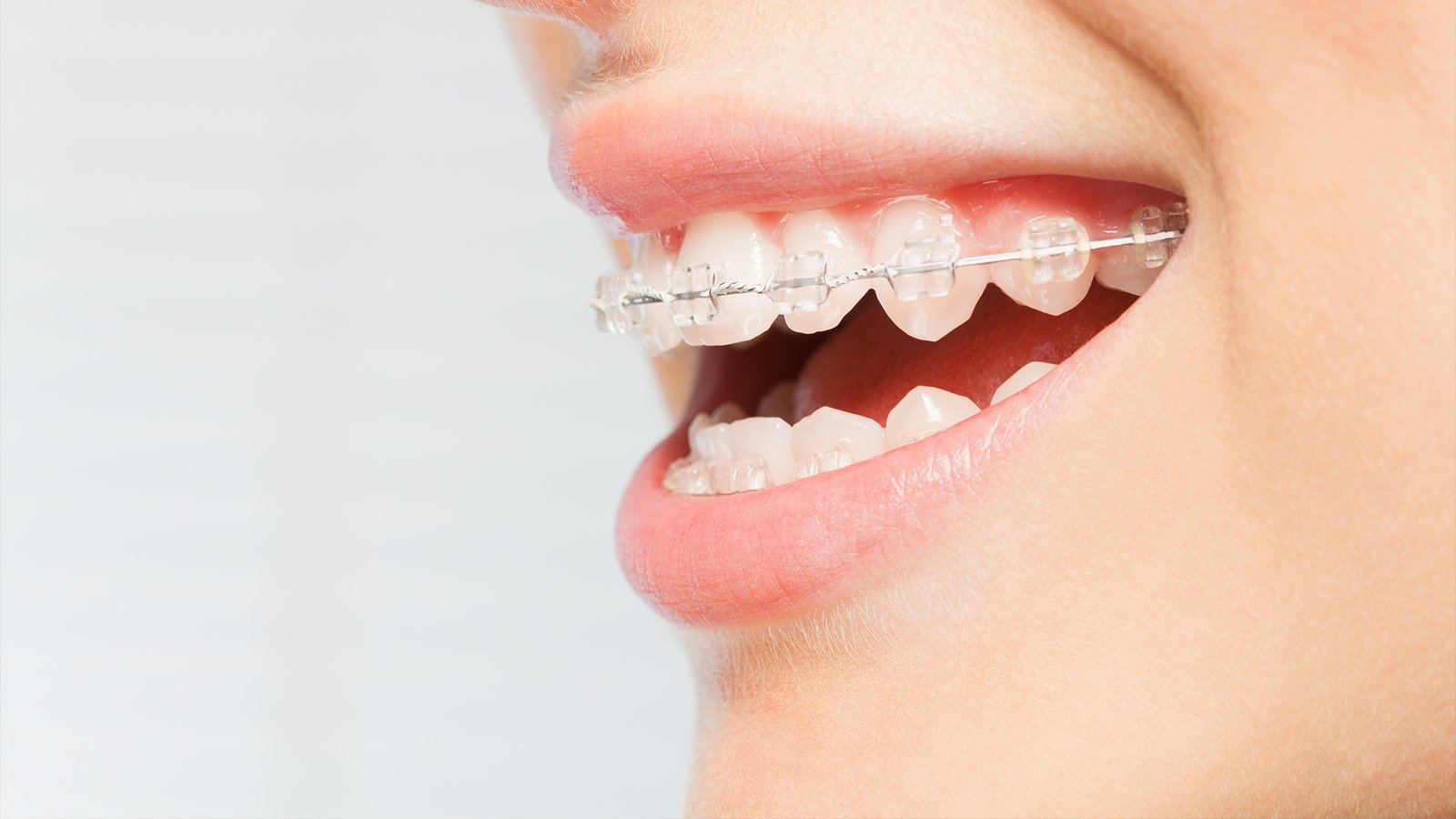 clear braces: The key to a confident, aligned smile?