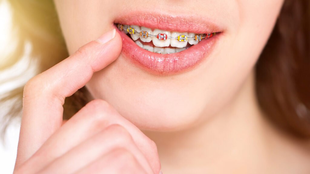 colored braces
