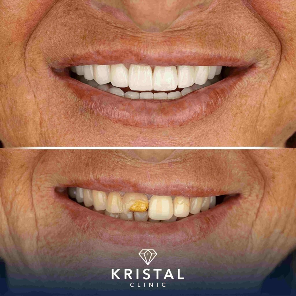 hollywood smile vs veneers