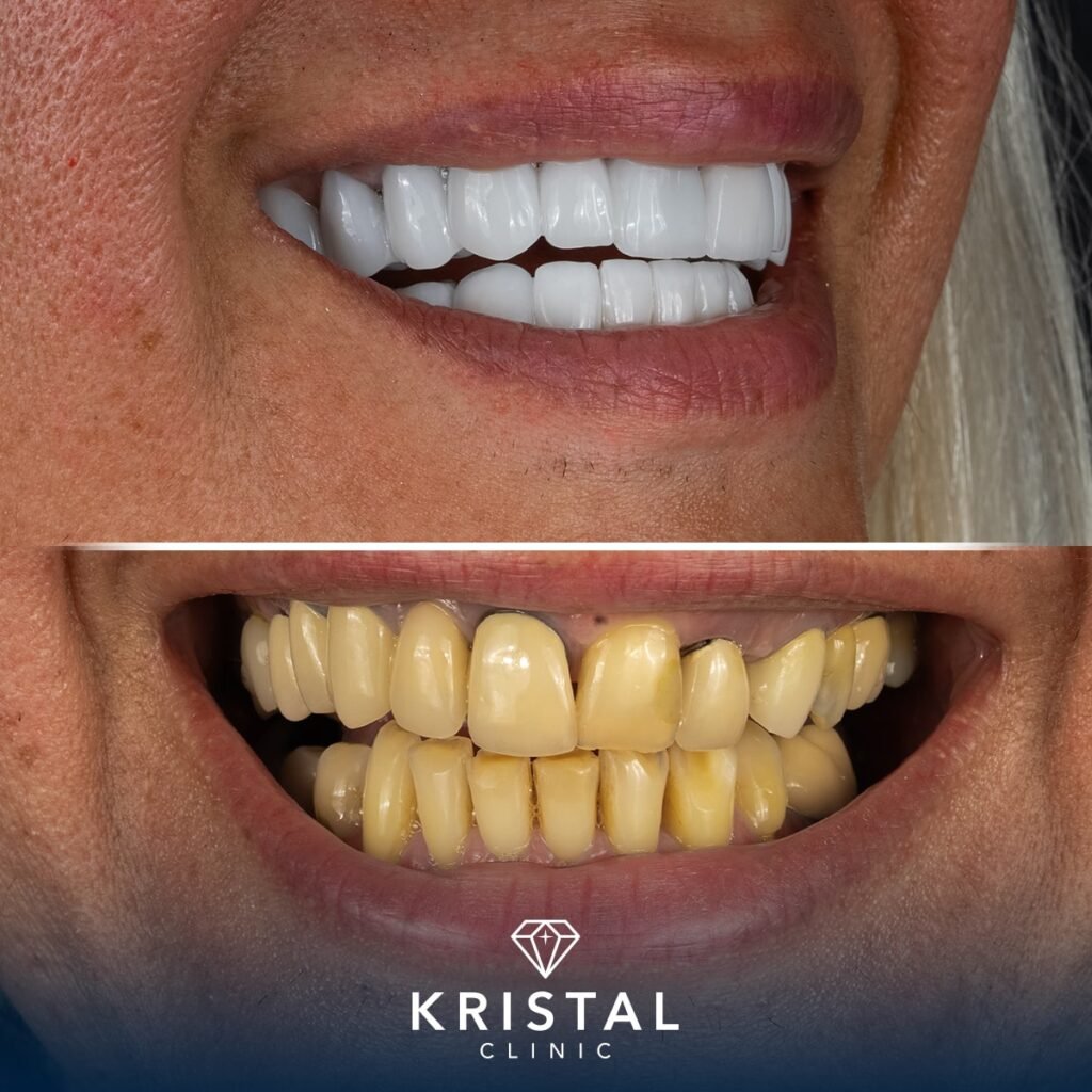 All on 4 Dental Implants