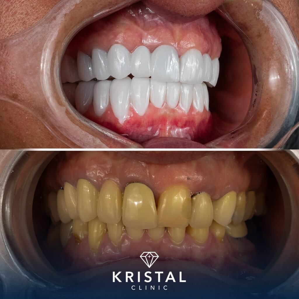 Dental Implant Cost