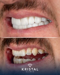 Hollywood Smile vs Veneers