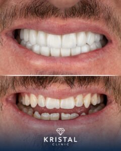 Hollywood Smile vs Veneers