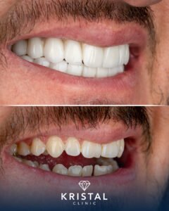 Hollywood Smile vs Veneers
