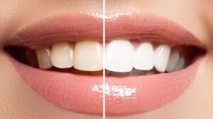 hollywood smile