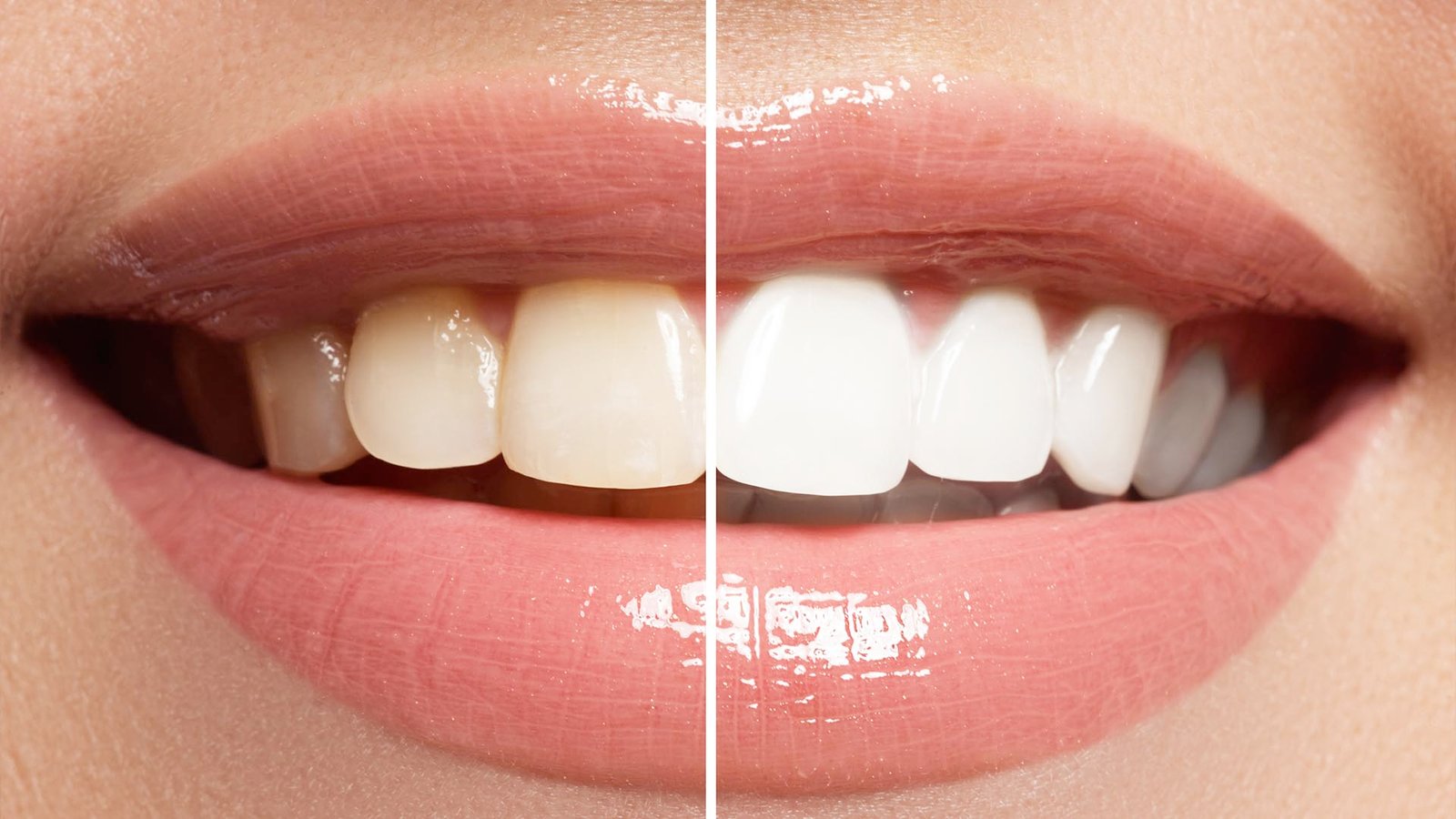 What is a hollywood smiles?