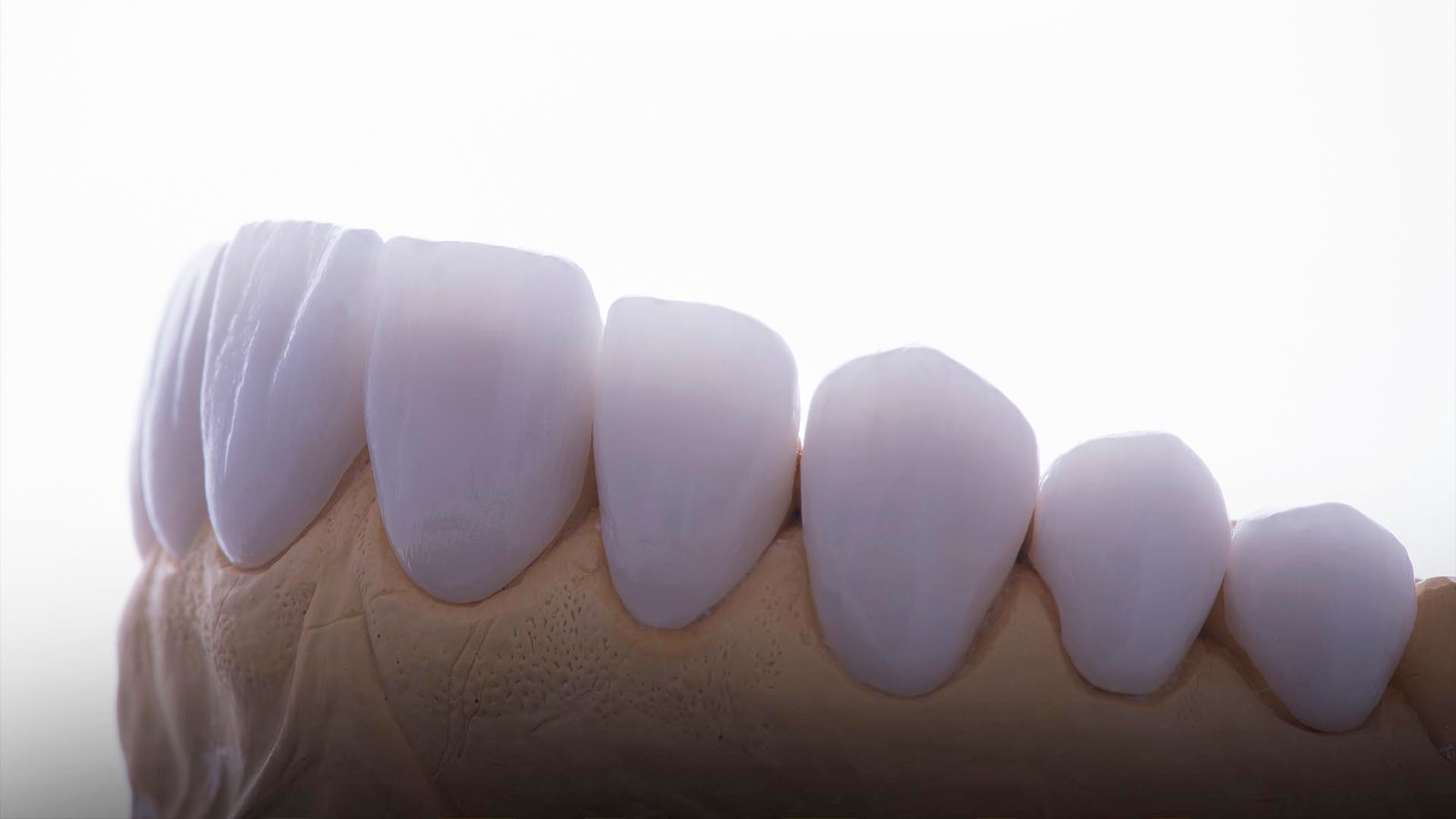 veneer teeth process step by step Kristal Clinic