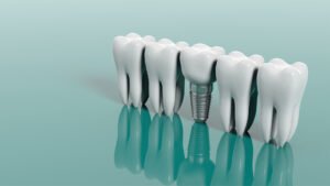 dental implant clear choice