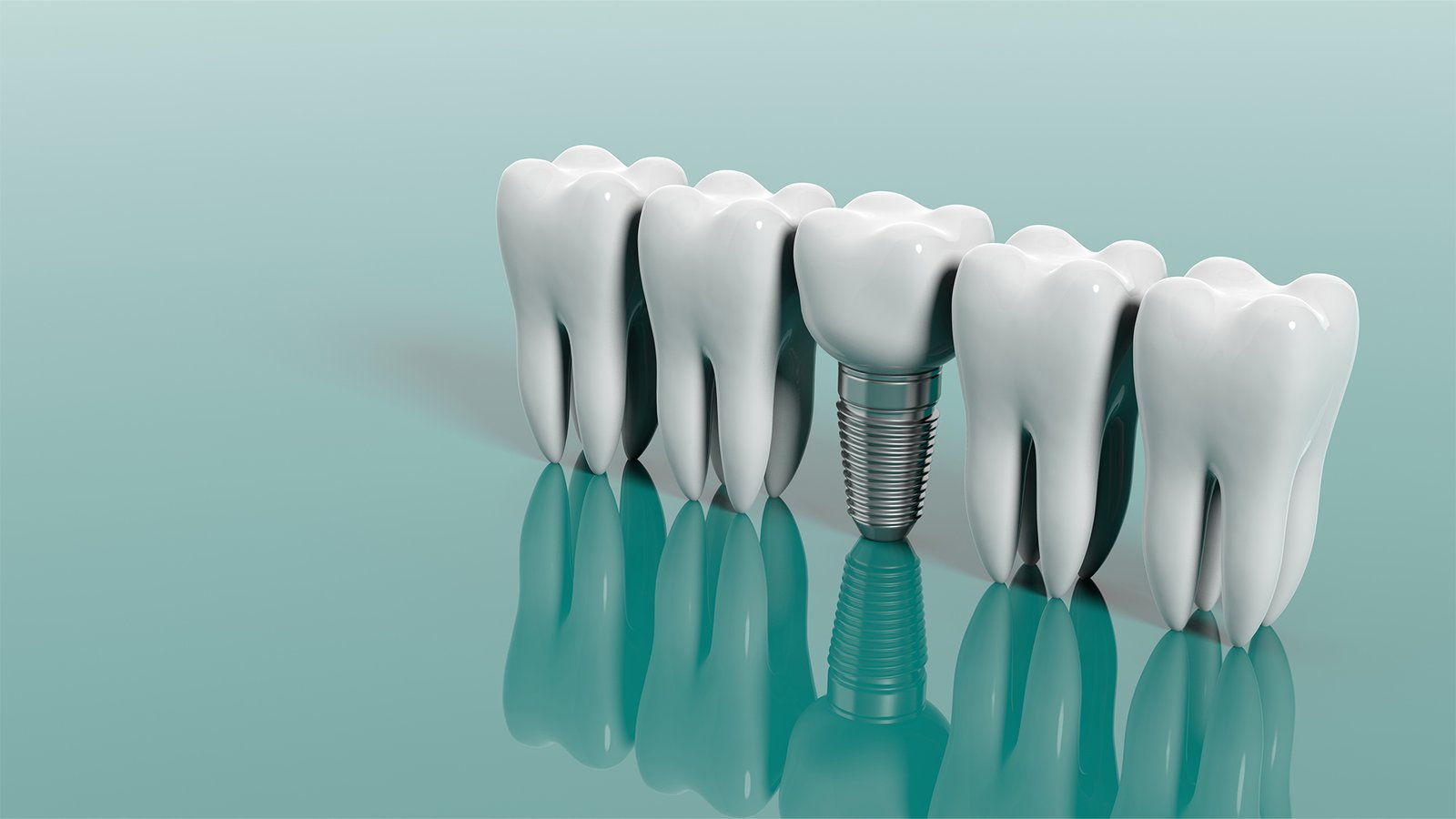 Clear Choice Dental Implants: A Trusted Solution