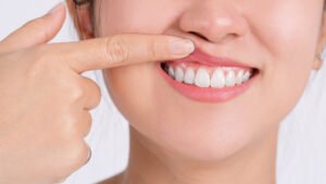 gingivitis healthy gums