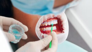 best teeth whitening product