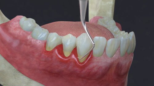 gingivitis vs periodontal disease
