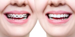 teeth braces vs invisalign