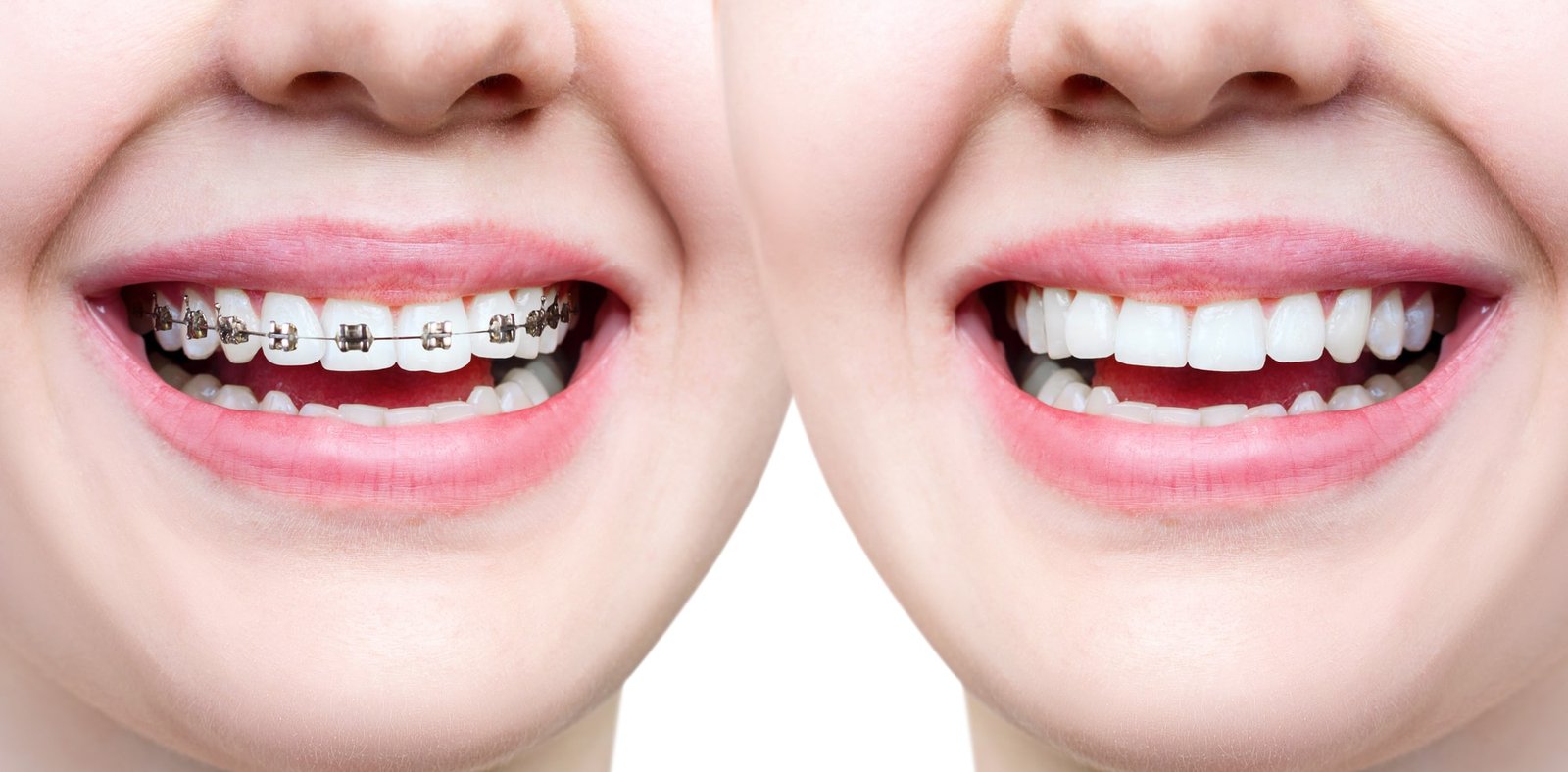 teeth braces vs invisalign : which wins ?