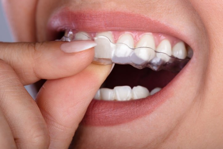 best way to whiten teeth