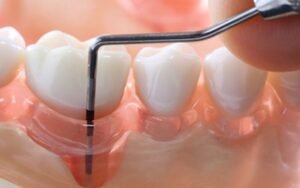 gingivitis vs periodontal disease