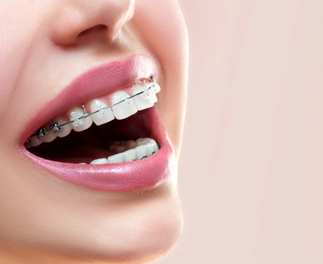 Does smile direct club actually deliver results?