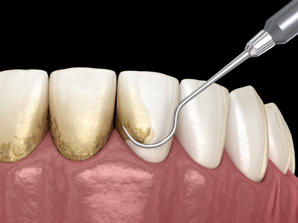 gingivitis vs periodontal disease