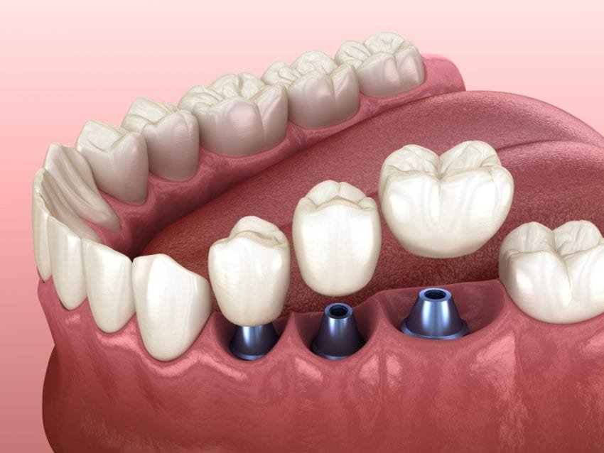 How Much Do Composite Resin Veneers Cost?