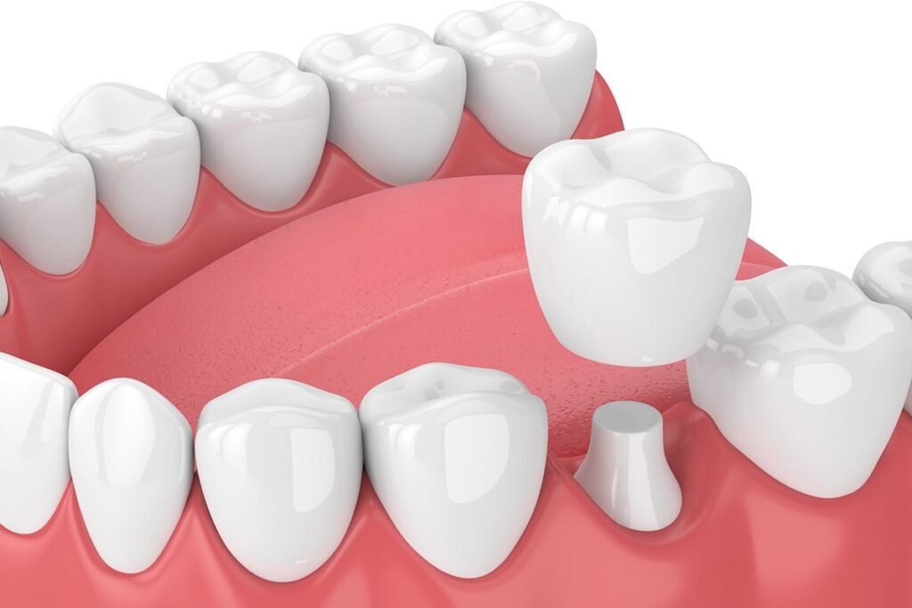 dental crown cost