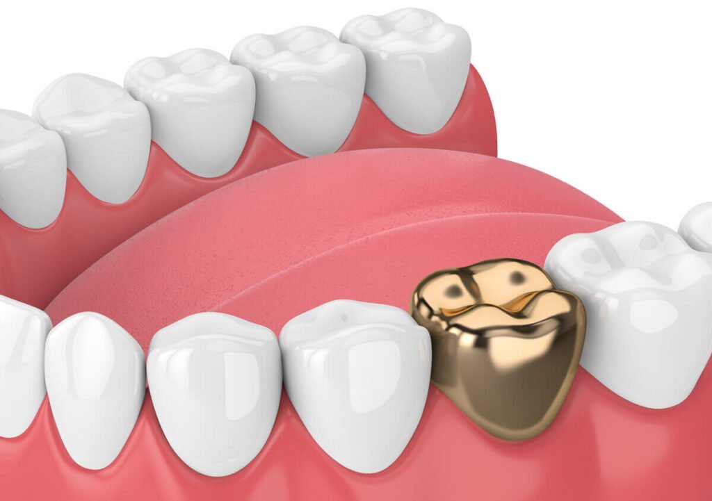 dental crown cost