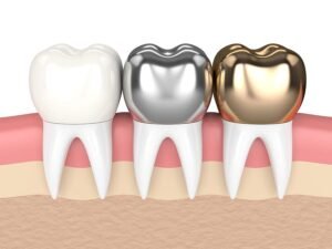 dental implants and bridges