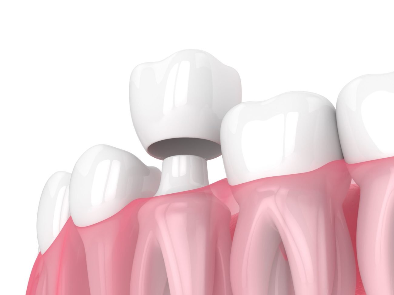 what influences the cost of a teeth crown?