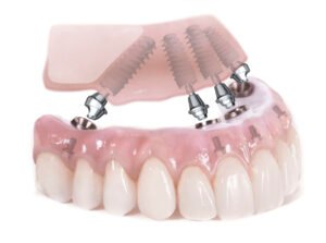 dental implants all on four