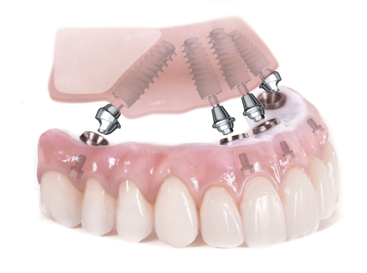 Dental Implants All on Four | Get Your Smile Back Fast