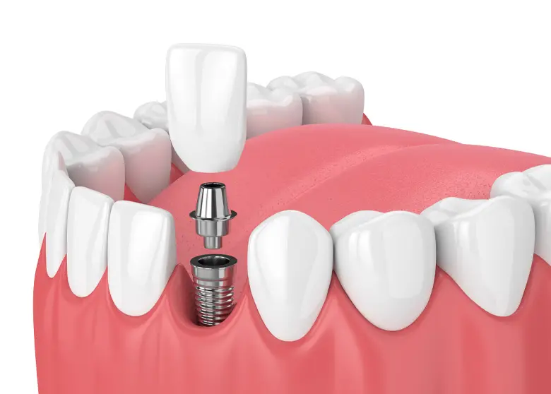 Discover the Benefits of Zirconium Dental Implants
