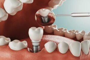 implant discomfort