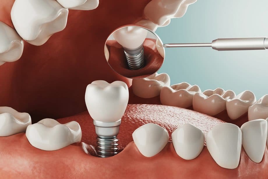 Dental Implant Healing Stages: A Complete Recovery Guide