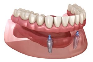 dental implant overdenture
