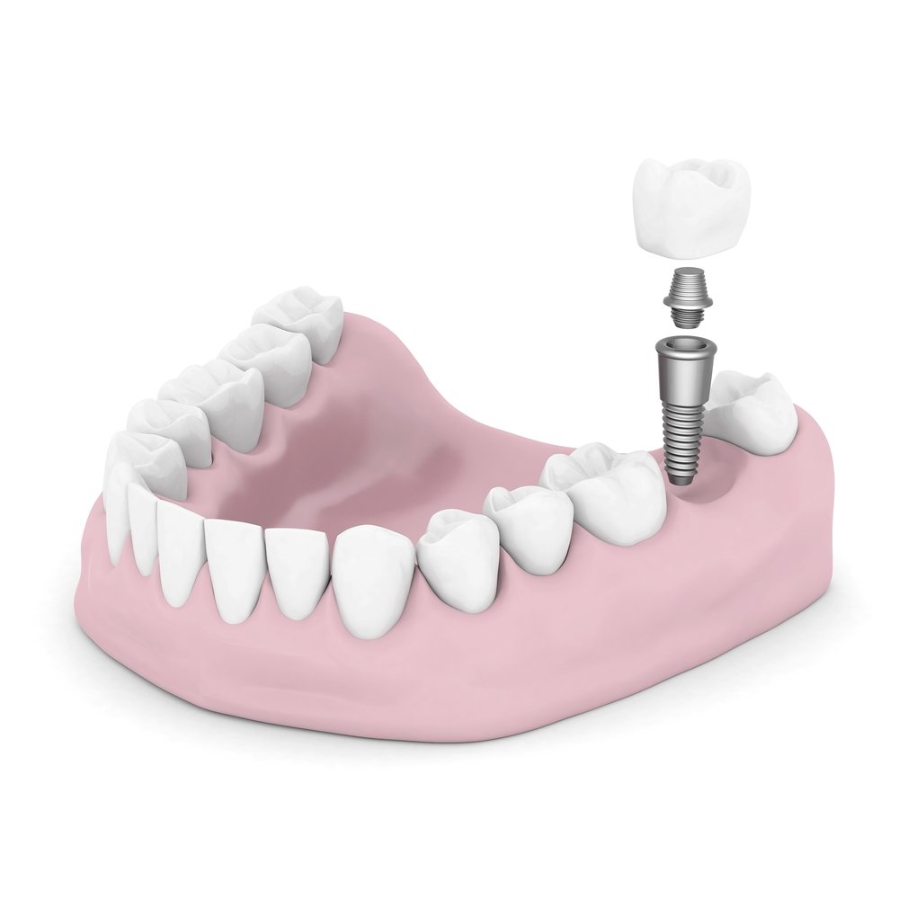 dental implants all on four