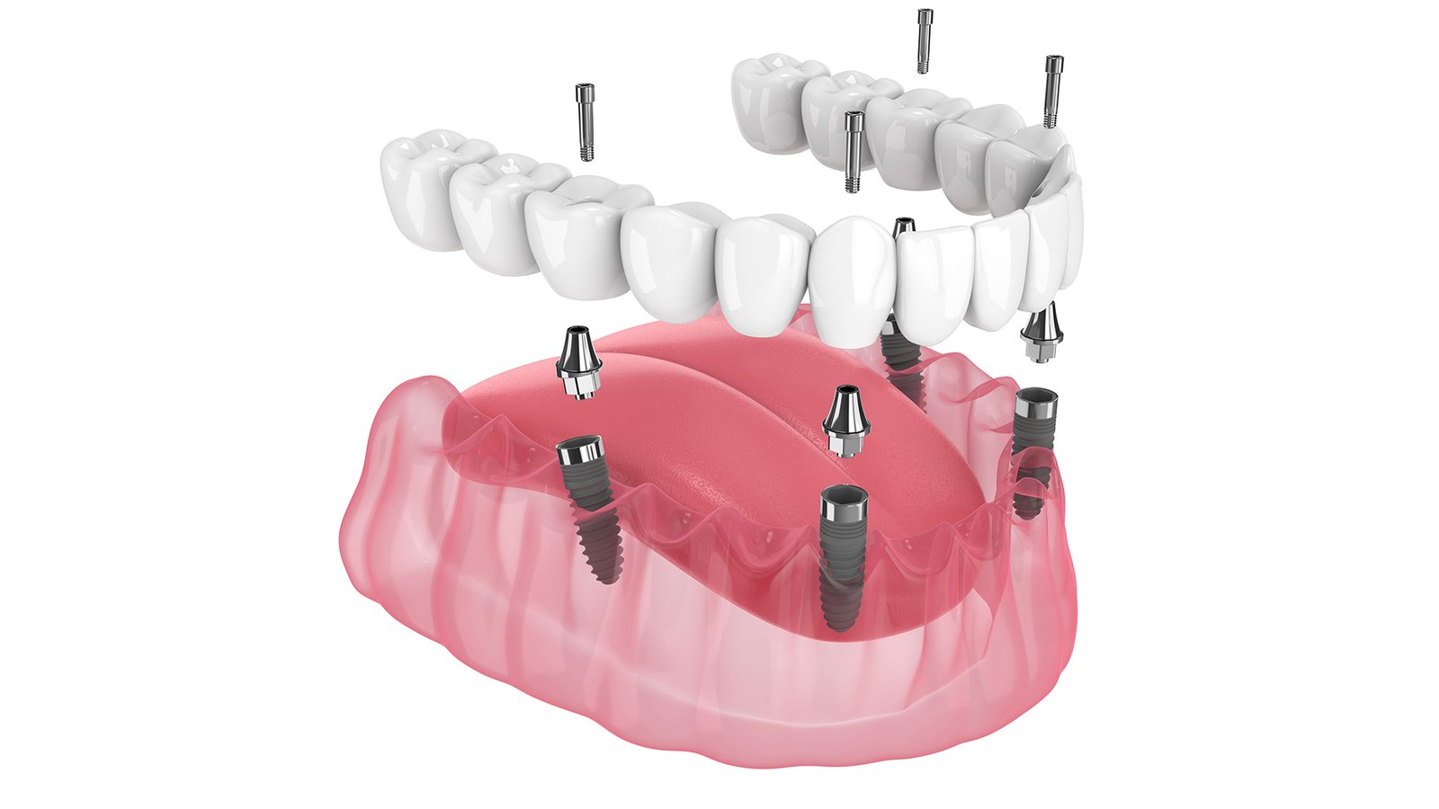 3 on 6 Dental Implants Turkey for a Perfect Smile