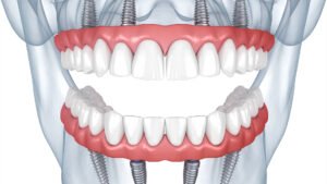 full mouth dental implants antalya