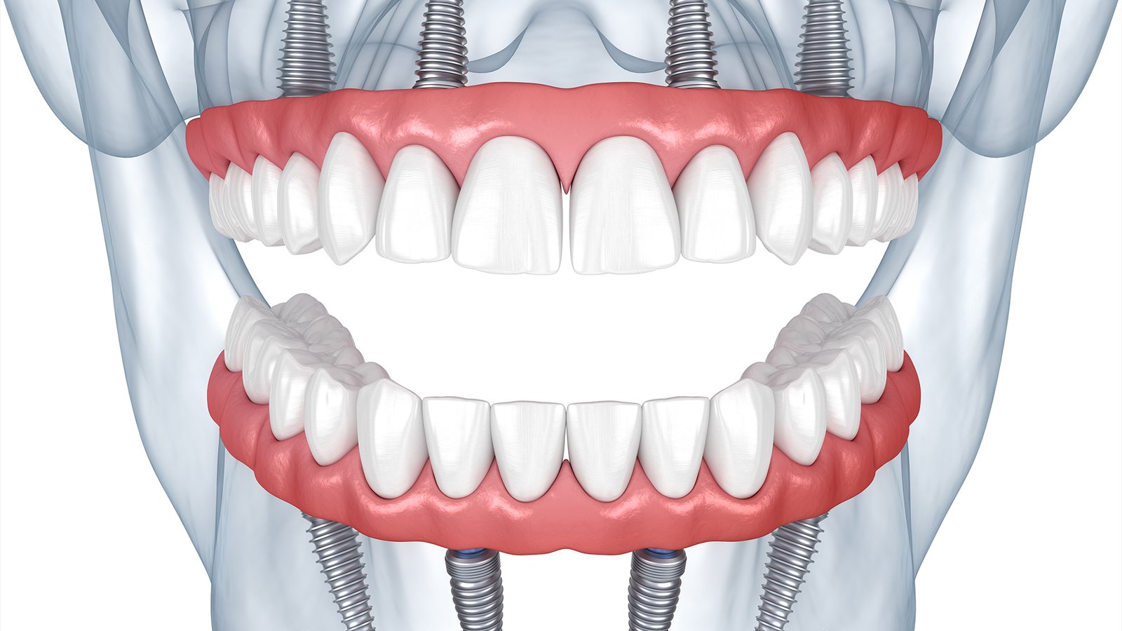 Full Mouth Dental Implants Antalya: A Perfect Smile