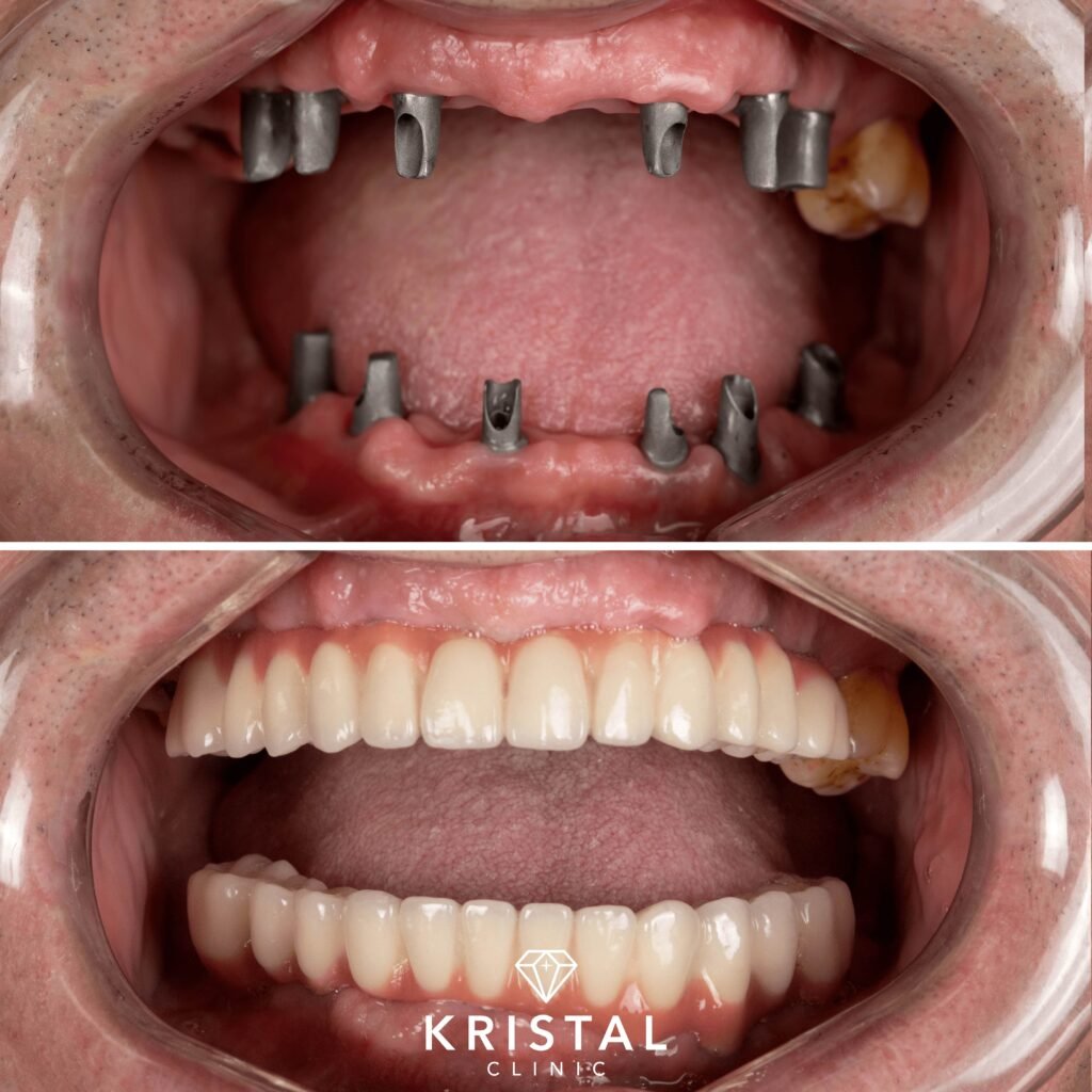 affordable dental implants