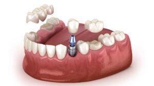 all on 4 dental implants zirconia