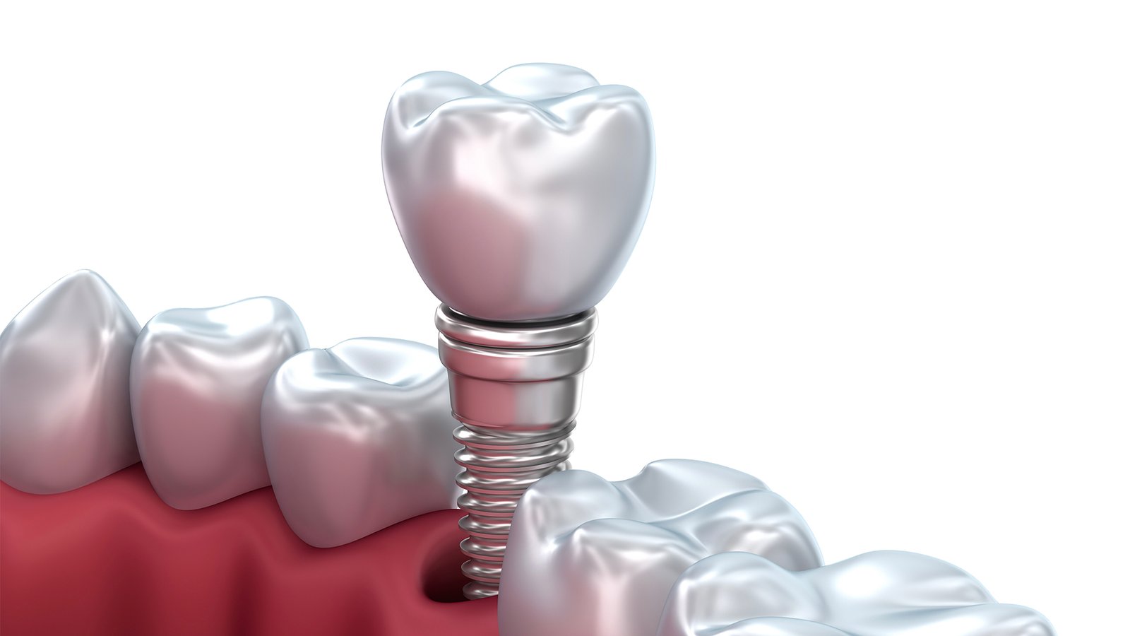 Disadvantages of Mini Dental Implants: What You Need to Know