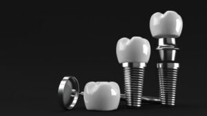 maximum time between bone graft and dental implant