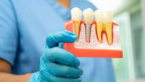permanent dentures celebrity dental implants before and after