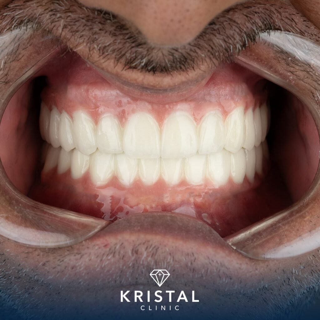 how long does dental implant take