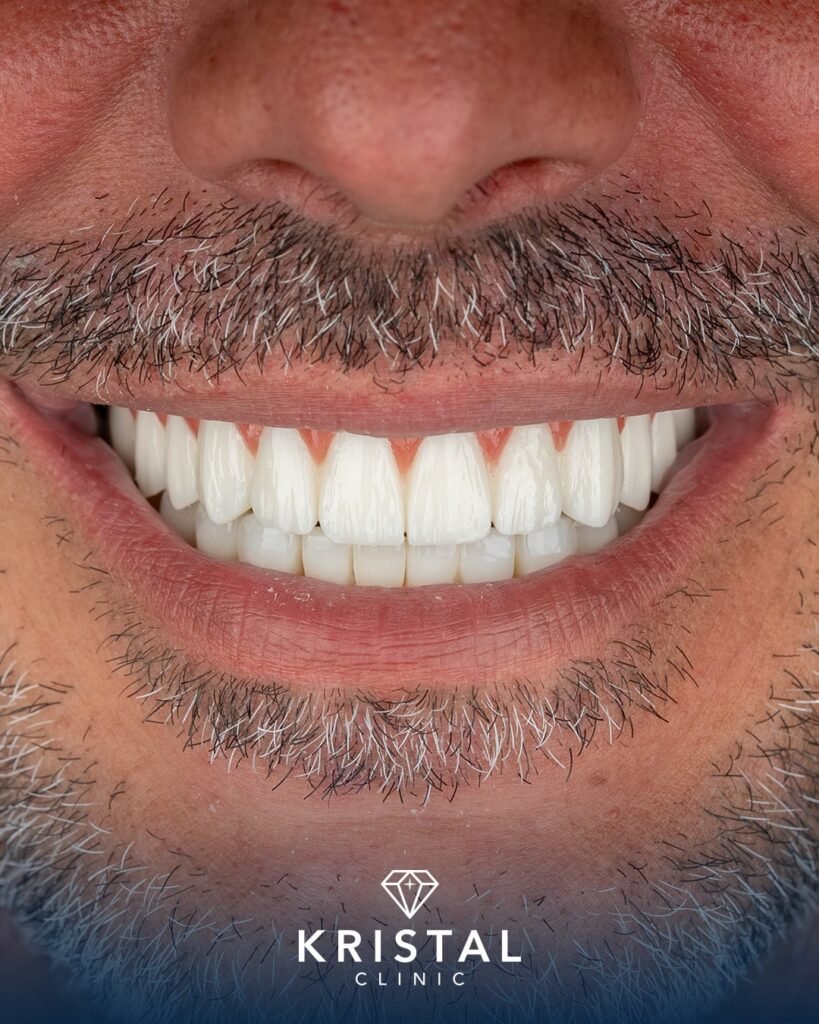 Permanent Dentures Celebrity Dental Implants Before and After